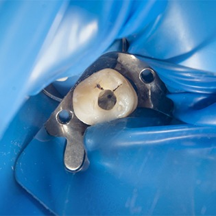 A dental dam being used to isolate the tooth in need of a root canal