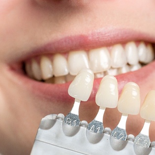 An up-close view of a dentist using a shade guide to determine the correct color for a patient’s veneers