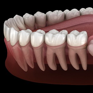 Illustration of an impacted wisdom tooth