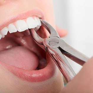 Dental forceps about to remove an infected tooth