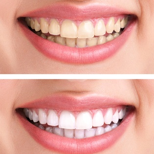 Rubber Bands Blog  Studio Dental of River ParkGet a Brighter Smile with  Our Professional Teeth Whitening Services - Studio Dental of River Park