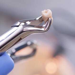 a person holding an extracted tooth with forceps