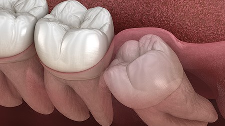 A dentist pointing out a patient’s impacted wisdom tooth